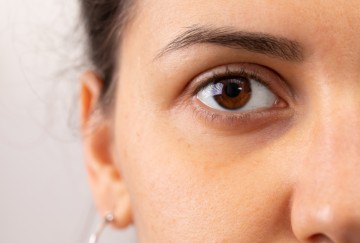 Top Causes of Dark Circles and How to Treat Them
