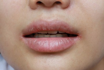 How To Treat Cracked Lip Corners In Simple Steps